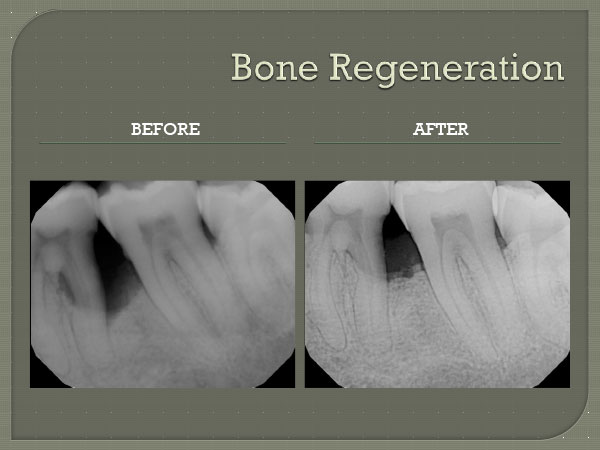 Pembroke Pines Bone Regeneration